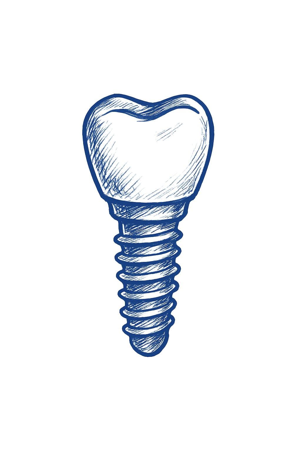 Implantes Dentales Bogotá - Vargas Odontología Integral