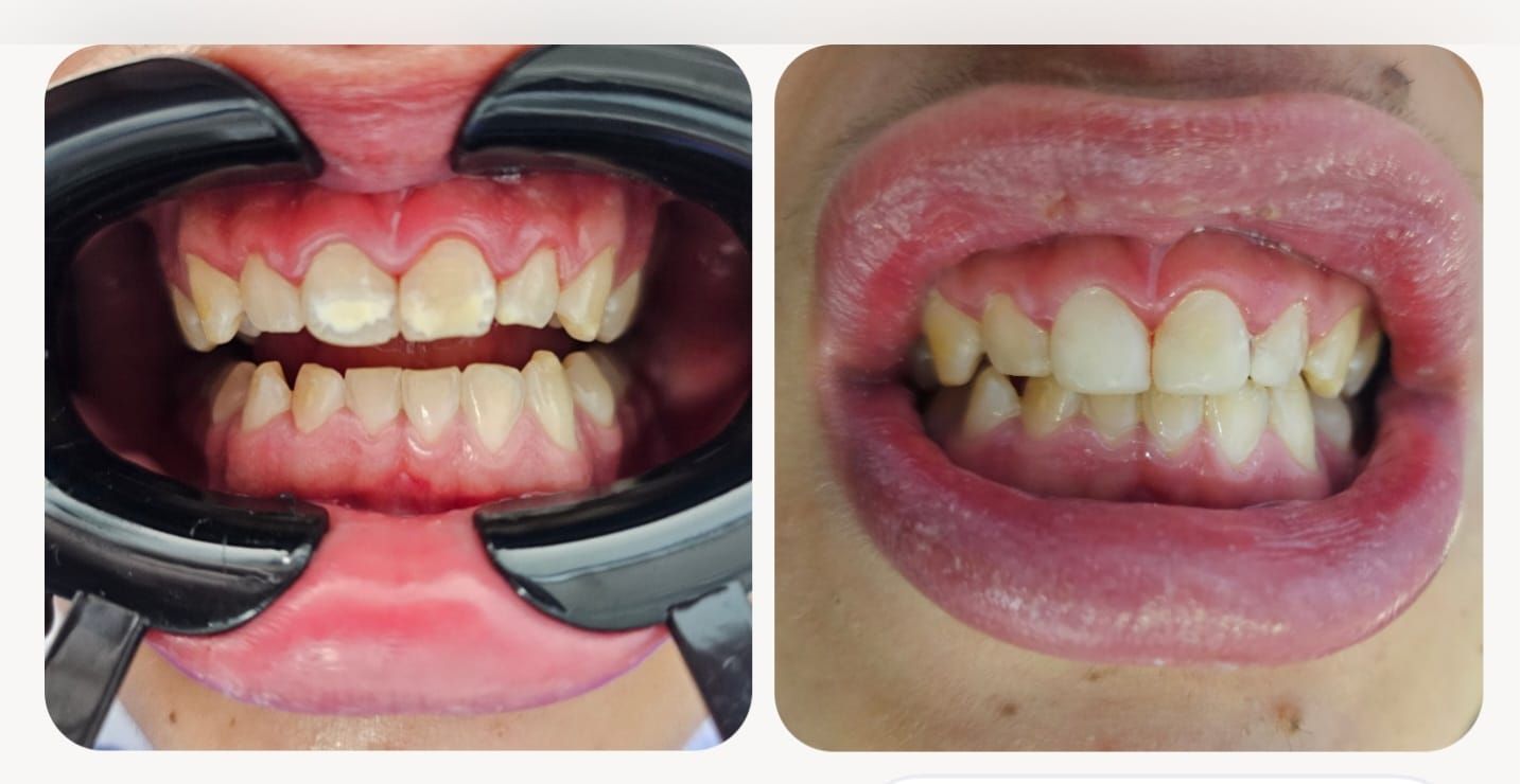 Antes y Después - Tratamiento Dental