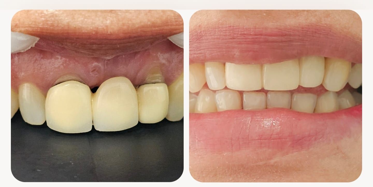 Antes y Después - Tratamiento Dental